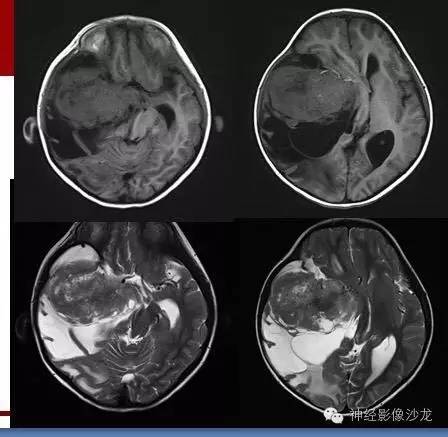 【病例】婴幼儿促纤维增生性星形细胞瘤一例