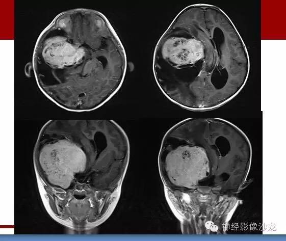 【病例】婴幼儿促纤维增生性星形细胞瘤一例