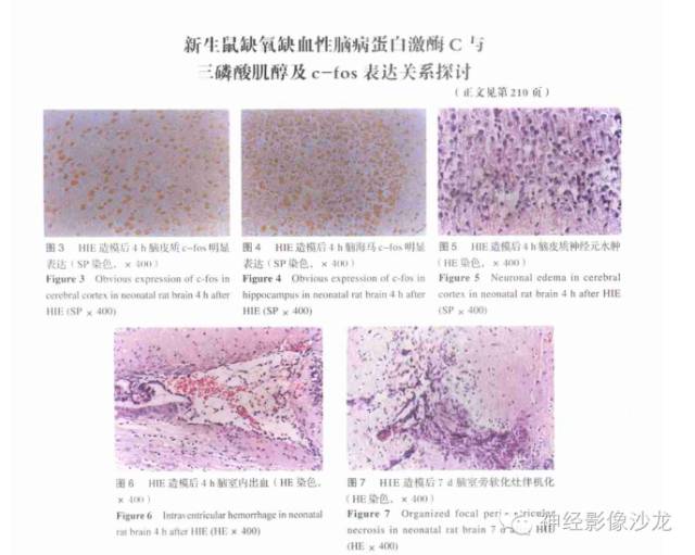 【病例】婴幼儿促纤维增生性星形细胞瘤一例