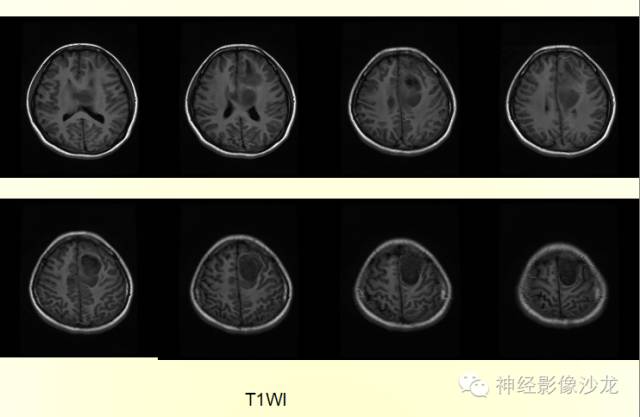 【病例】幕上原始神经外胚层肿瘤PNET一例MR影像表现