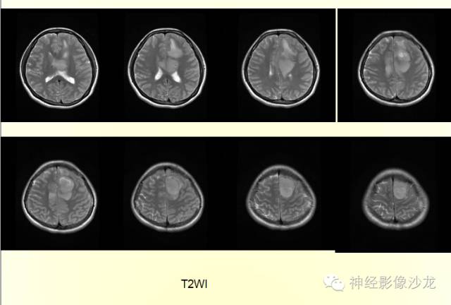 【病例】幕上原始神经外胚层肿瘤PNET一例MR影像表现