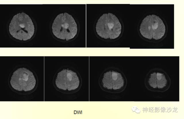 【病例】幕上原始神经外胚层肿瘤PNET一例MR影像表现