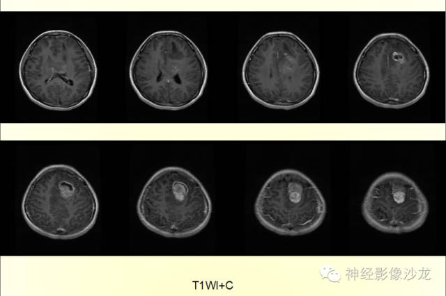 【病例】幕上原始神经外胚层肿瘤PNET一例MR影像表现
