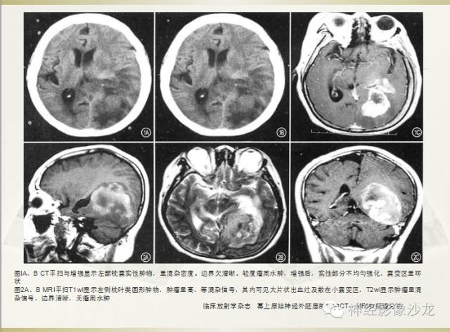【病例】幕上原始神经外胚层肿瘤PNET一例MR影像表现