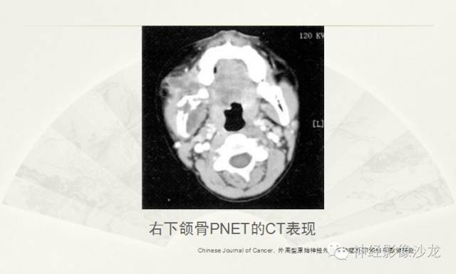 【病例】幕上原始神经外胚层肿瘤PNET一例MR影像表现