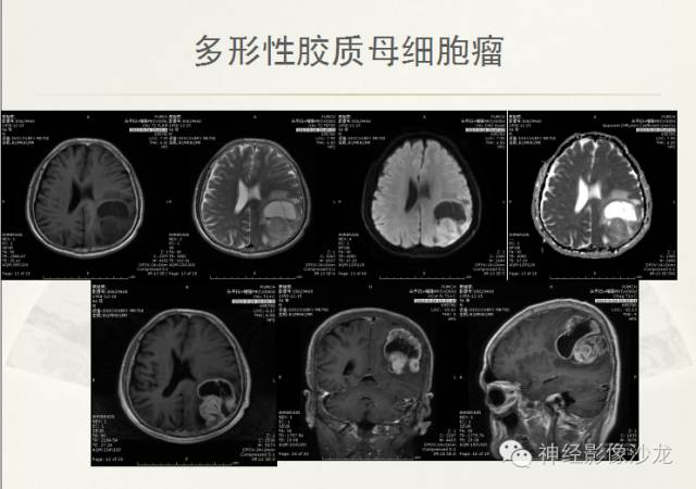 【病例】幕上原始神经外胚层肿瘤PNET一例MR影像表现