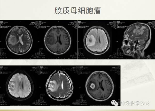 【病例】幕上原始神经外胚层肿瘤PNET一例MR影像表现