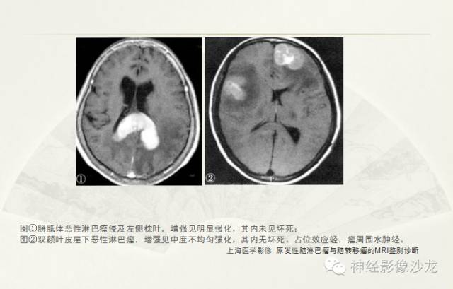 【病例】幕上原始神经外胚层肿瘤PNET一例MR影像表现