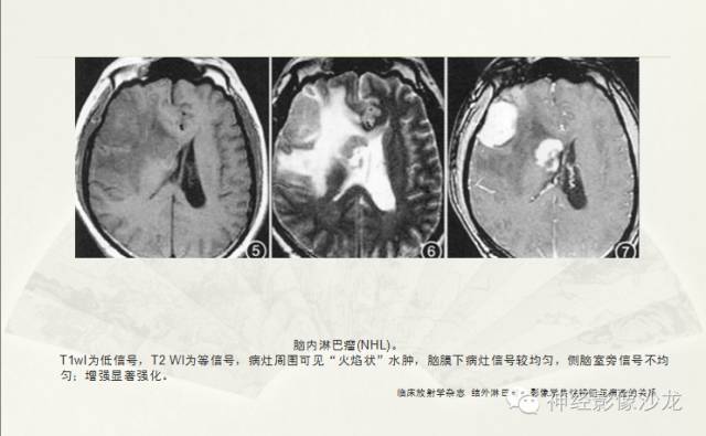 【病例】幕上原始神经外胚层肿瘤PNET一例MR影像表现