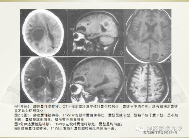 【病例】幕上原始神经外胚层肿瘤PNET一例MR影像表现