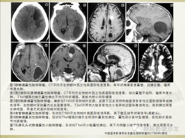 【病例】幕上原始神经外胚层肿瘤PNET一例MR影像表现