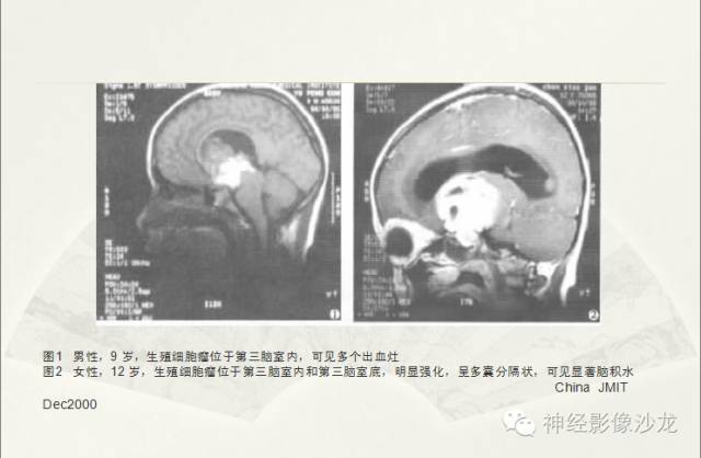 【病例】幕上原始神经外胚层肿瘤PNET一例MR影像表现