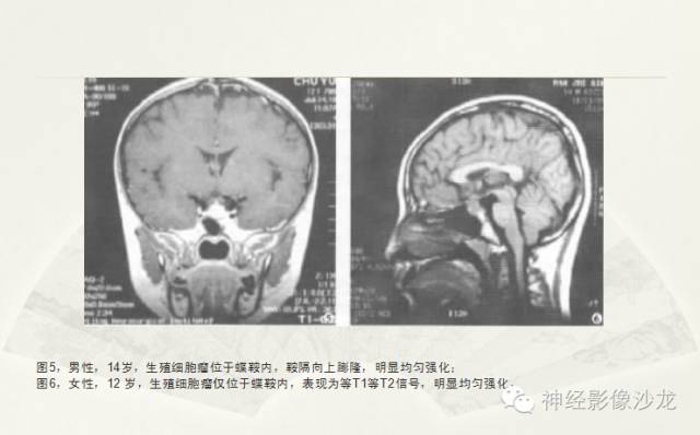 【病例】幕上原始神经外胚层肿瘤PNET一例MR影像表现