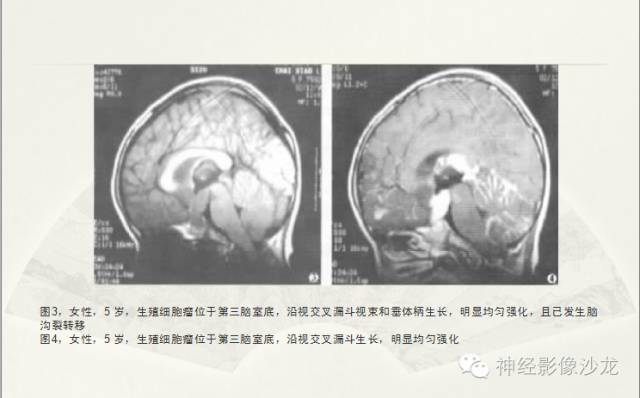 【病例】幕上原始神经外胚层肿瘤PNET一例MR影像表现