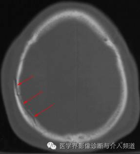 透过典型表现，轻松学头颅外伤CT