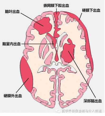 透过典型表现，轻松学头颅外伤CT