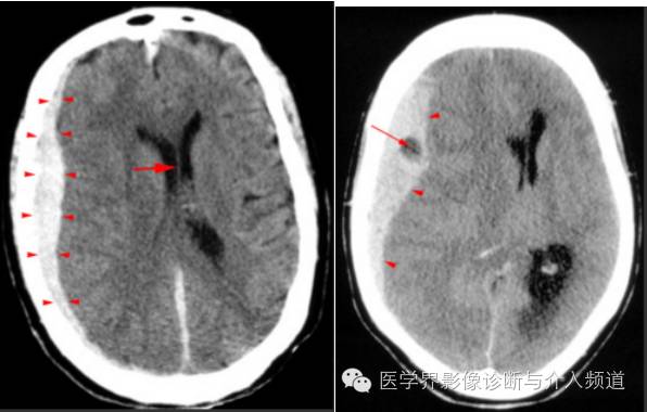 透过典型表现，轻松学头颅外伤CT