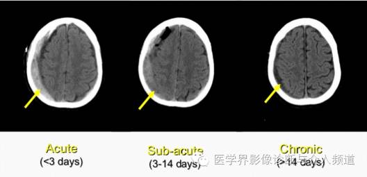 透过典型表现，轻松学头颅外伤CT