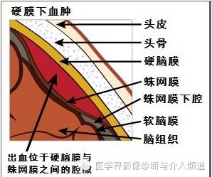透过典型表现，轻松学头颅外伤CT