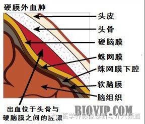透过典型表现，轻松学头颅外伤CT