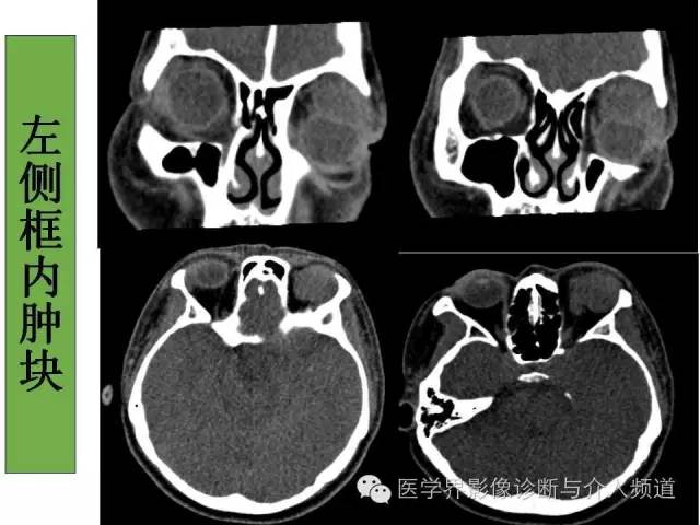 【病例】泪腺多形性腺瘤1例CT及MR影像表现