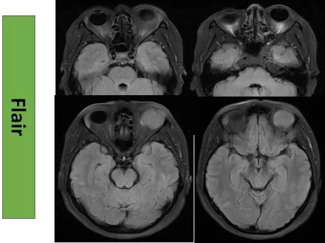 【病例】泪腺多形性腺瘤1例CT及MR影像表现