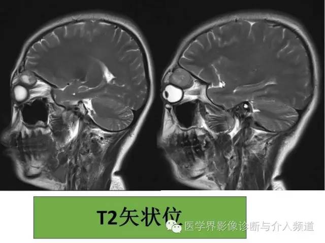 【病例】泪腺多形性腺瘤1例CT及MR影像表现