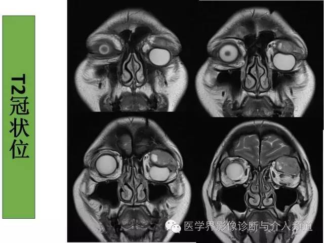 【病例】泪腺多形性腺瘤1例CT及MR影像表现