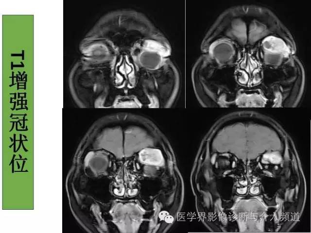 【病例】泪腺多形性腺瘤1例CT及MR影像表现