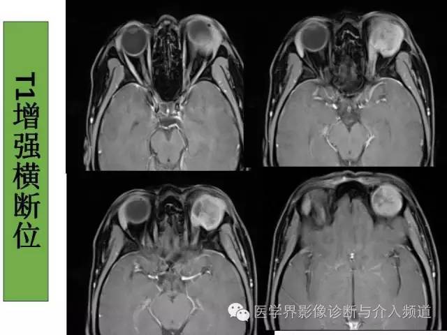【病例】泪腺多形性腺瘤1例CT及MR影像表现