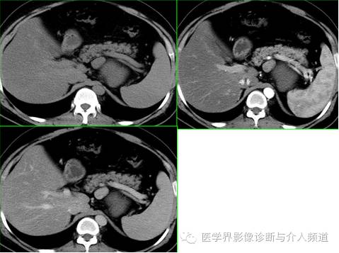 【病例】腹膜后节细胞神经瘤3例CT及MR影像表现
