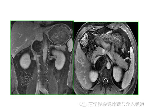 【病例】腹膜后节细胞神经瘤3例CT及MR影像表现