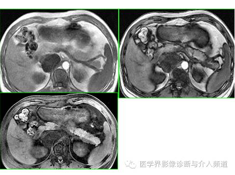 【病例】腹膜后节细胞神经瘤3例CT及MR影像表现