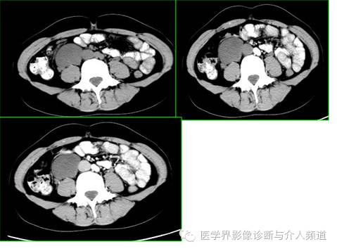 【病例】腹膜后节细胞神经瘤3例CT及MR影像表现