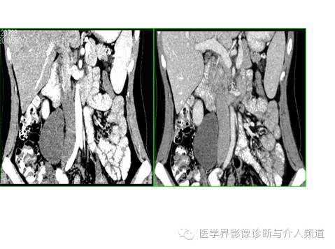 【病例】腹膜后节细胞神经瘤3例CT及MR影像表现
