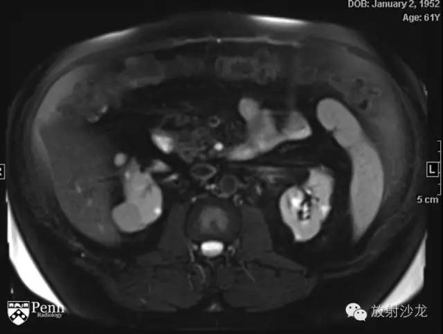 【病例】乳头状肾细胞癌1例CT影像表现