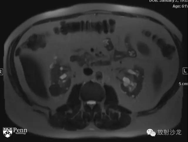 【病例】乳头状肾细胞癌1例CT影像表现