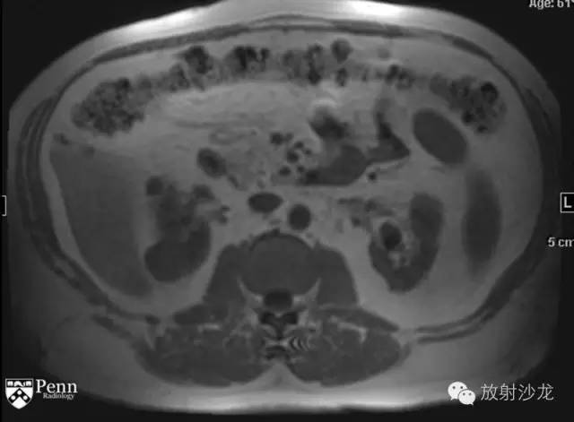 【病例】乳头状肾细胞癌1例CT影像表现