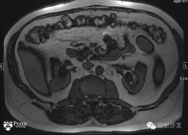 【病例】乳头状肾细胞癌1例CT影像表现