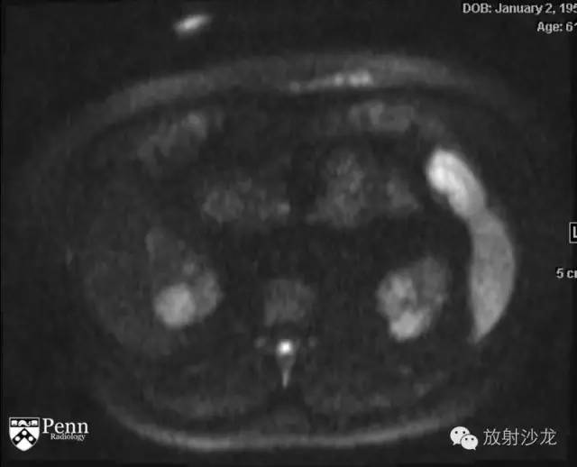 【病例】乳头状肾细胞癌1例CT影像表现