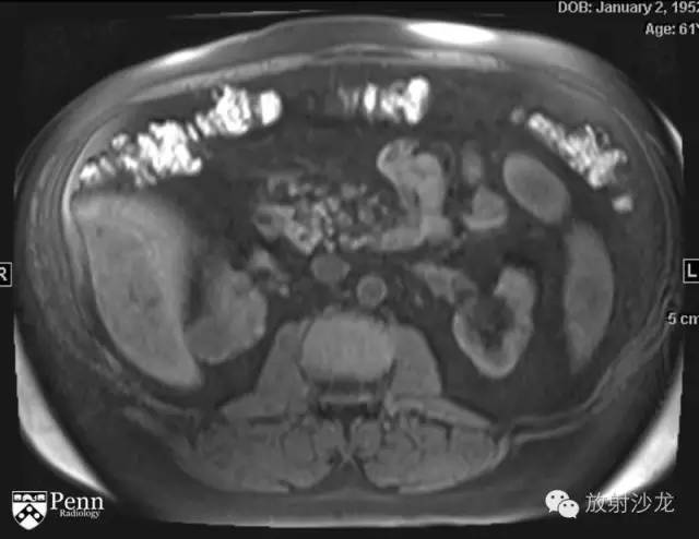 【病例】乳头状肾细胞癌1例CT影像表现