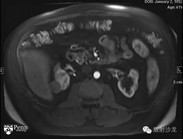 【病例】乳头状肾细胞癌1例CT影像表现