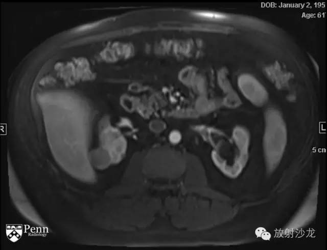 【病例】乳头状肾细胞癌1例CT影像表现