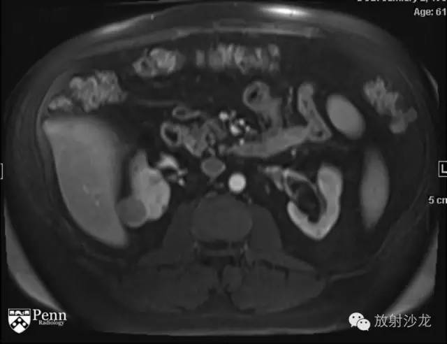 【病例】乳头状肾细胞癌1例CT影像表现