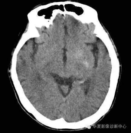 【病例】糖尿病非酮症性高渗状态所致偏侧舞蹈症1例MR影像表现