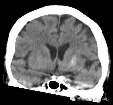 【病例】糖尿病非酮症性高渗状态所致偏侧舞蹈症1例MR影像表现 【病例】糖尿病非酮症性高渗状态所致偏侧舞蹈症1例MR影像表现