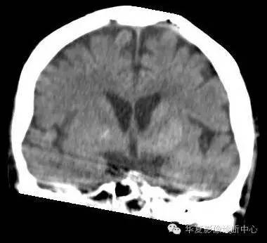 【病例】糖尿病非酮症性高渗状态所致偏侧舞蹈症1例MR影像表现 【病例】糖尿病非酮症性高渗状态所致偏侧舞蹈症1例MR影像表现