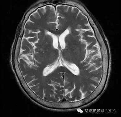 【病例】糖尿病非酮症性高渗状态所致偏侧舞蹈症1例MR影像表现 【病例】糖尿病非酮症性高渗状态所致偏侧舞蹈症1例MR影像表现