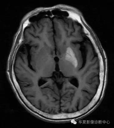【病例】糖尿病非酮症性高渗状态所致偏侧舞蹈症1例MR影像表现 【病例】糖尿病非酮症性高渗状态所致偏侧舞蹈症1例MR影像表现