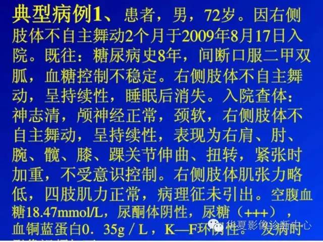 【病例】糖尿病非酮症性高渗状态所致偏侧舞蹈症1例MR影像表现 【病例】糖尿病非酮症性高渗状态所致偏侧舞蹈症1例MR影像表现